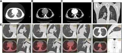 Case report: Primary alveolar soft-part sarcoma of the lung in a child